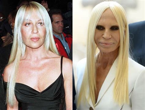 donatella versace chirurgie|Donatella Versace before and after.